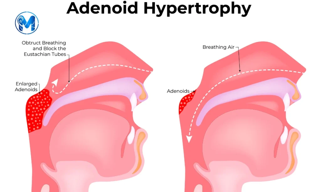 Adenoid-Hypertrophy